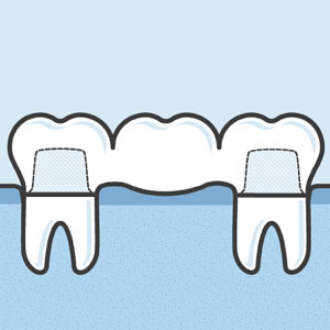 Illustration of dental bridge