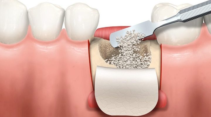 BONE GRAFTING OPTIONS: CHOOSING THE RIGHT SOLUTION FOR DENTAL IMPLANTS Titanium Membrane Placement