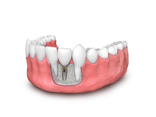 BONE GRAFTING OPTIONS: CHOOSING THE RIGHT SOLUTION FOR DENTAL IMPLANTS The Complexity of Bone Grafting