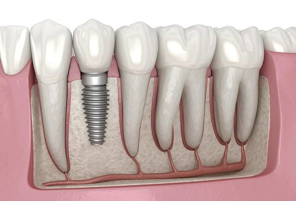 BONE GRAFTING OPTIONS: CHOOSING THE RIGHT SOLUTION FOR DENTAL IMPLANTS dental implant treatment