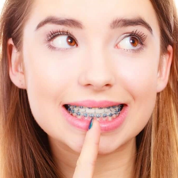 Young woman smiling with braces.