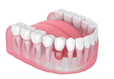 PERIODONTITIS