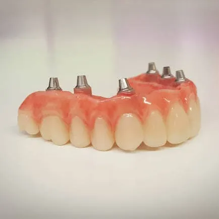 ham gia gan tren implant